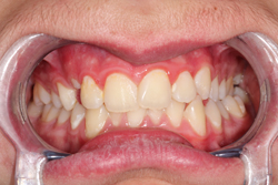 Misaligned Teeth