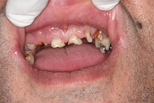 Teeth Broken Fillings